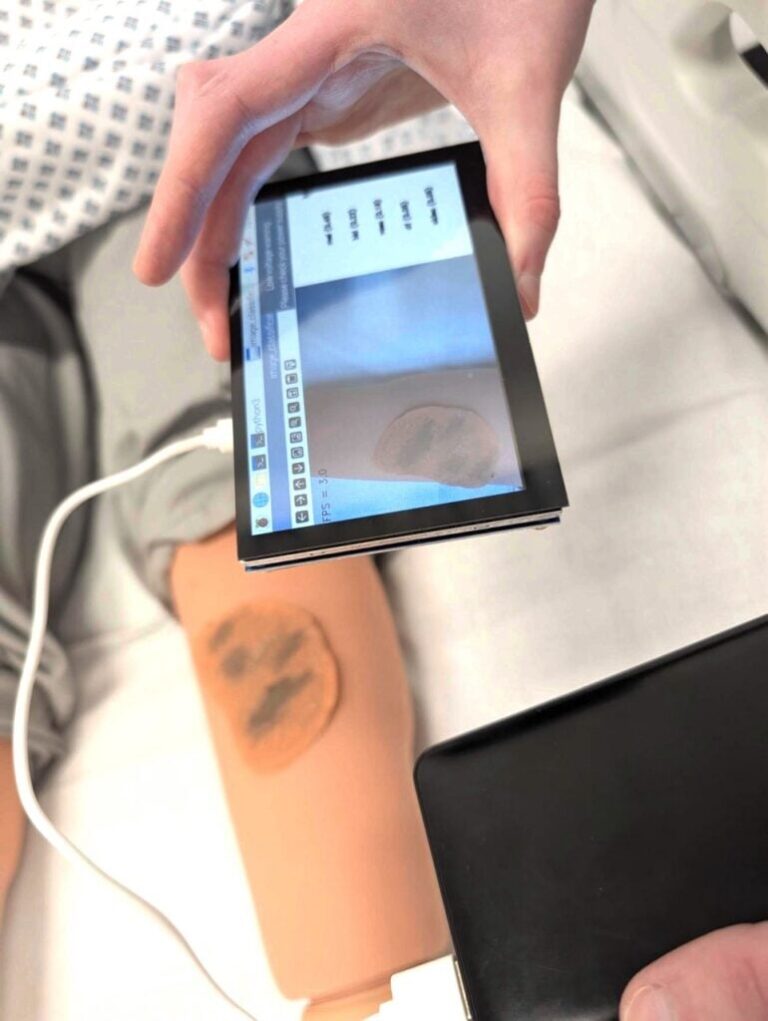 TinyML on a Raspberry Pi 3: LesionIQ Scans Skin Lesions Offline